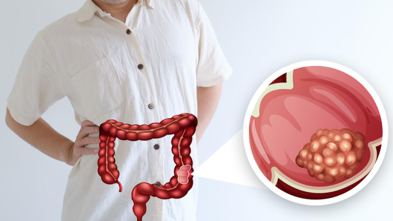 大腸癌蟬聯超過10年台灣癌症榜首 了解原因預防發病有方法
